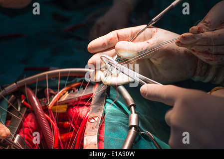 Anneau du clapet de suture dans la valve mitrale réparation Banque D'Images