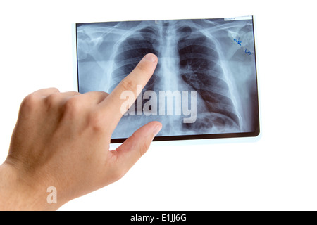 Homme main pointant sur la radiographie pulmonaire, isolé sur fond blanc Banque D'Images