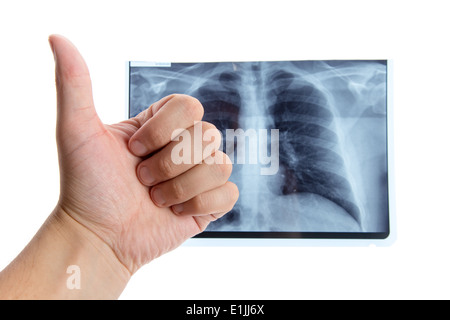 Main mâle showing Thumbs up à côté de la radiographie pulmonaire, isolé sur fond blanc Banque D'Images