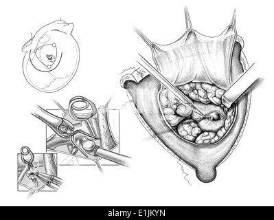 Craniotomie frontotemporale gauche postérieure pour anévrysme de l'artère de communication d'écrêtage. Banque D'Images