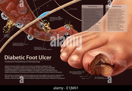 L'histopathologie et physiopathologie de la nourriture diabétique ulcères. Banque D'Images