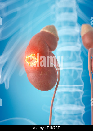 Rein humain montrant tumeur cancéreuse de l'oeuvre de l'ordinateur. Banque D'Images