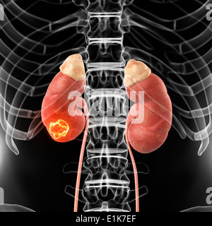 Rein humain montrant tumeur cancéreuse de l'oeuvre de l'ordinateur. Banque D'Images