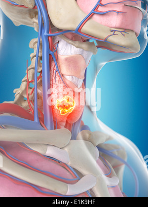 Les droits de l'glande thyroïde montrant une tumeur de l'oeuvre de l'ordinateur. Banque D'Images