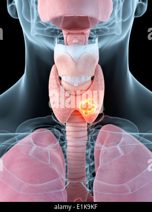 La thyroïde humaine montrant une tumeur de l'oeuvre de l'ordinateur. Banque D'Images