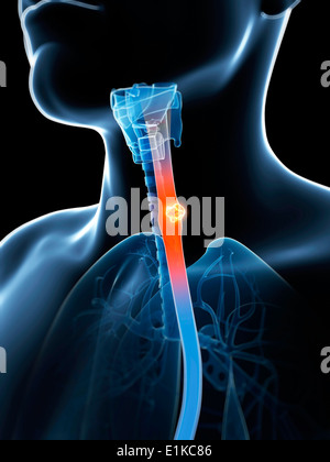 Les droits de l'oesophage avec l'oeuvre de l'ordinateur de la tumeur. Banque D'Images