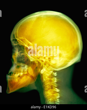 X-ray de couleur du crâne du crâne d'un homme de 30 ans. Banque D'Images