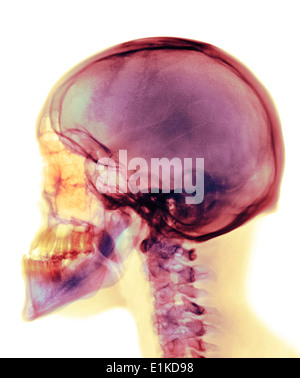 X-ray de couleur du crâne du crâne d'un homme de 30 ans. Banque D'Images