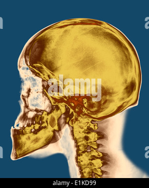 X-ray de couleur du crâne du crâne d'un homme de 30 ans. Banque D'Images