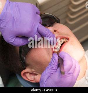 Boîtiers orthodontiques d'être montées sur les dents d'une adolescente de 14 ans au Royaume-Uni Banque D'Images