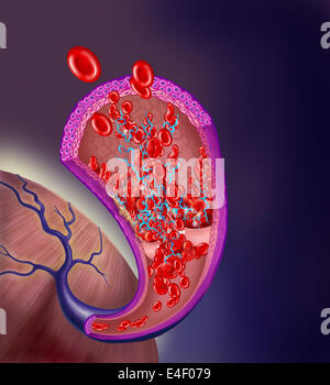 Le thrombus se forme sur l'intérieur de la soupape d'idées. Banque D'Images