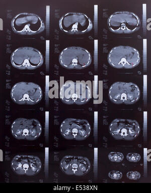 Libre d'un scanner CT avec la poitrine et l'abdomen, Banque D'Images