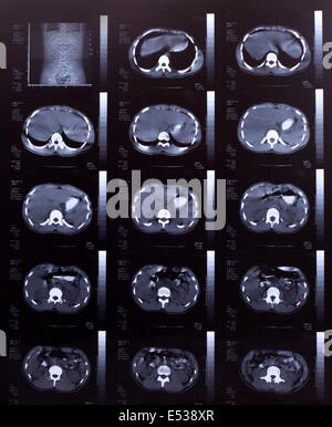 Libre d'un scanner CT avec la poitrine et l'abdomen, Banque D'Images