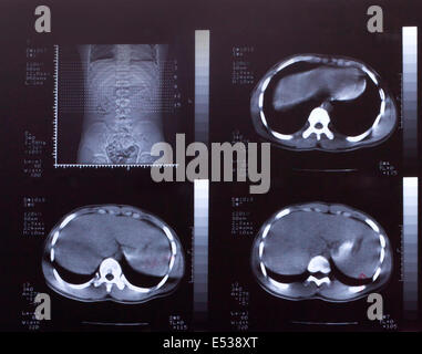 Libre d'un scanner CT avec la poitrine et l'abdomen, Banque D'Images