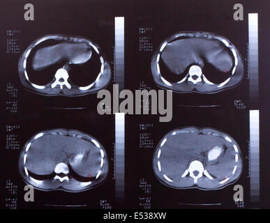 Libre d'un scanner CT avec la poitrine et l'abdomen, Banque D'Images