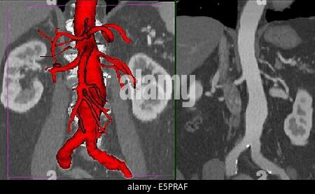 La tridimensionnelle (CT) reconstruction d'un anévrisme de l'aorte abdominale, il semble aussi enflée renflement Banque D'Images