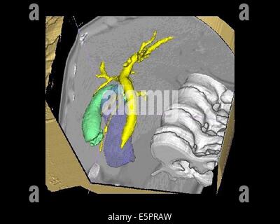 La tridimensionnelle (CT) de la reconstruction de la voie biliaire (jaune) et de la vésicule biliaire (vert) à partir de Banque D'Images