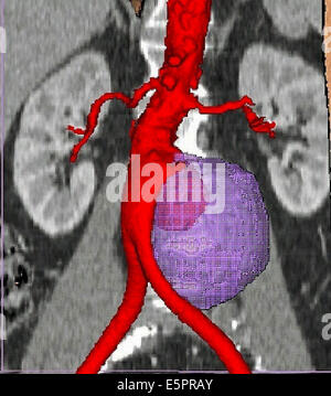 La tridimensionnelle (CT) reconstruction d'un anévrisme de l'aorte abdominale, il semble aussi enflée renflement Banque D'Images