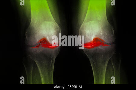 X-ray de genoux touchés par arthosis (vert). Banque D'Images