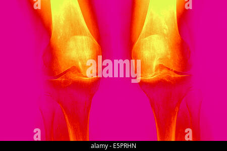 X-ray de genoux touchés par arthosis (vert). Banque D'Images