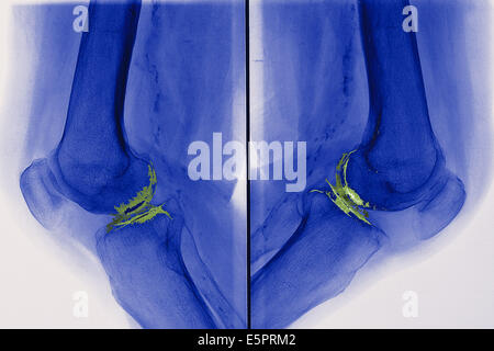 X-ray de genoux touchés par arthosis (vert), également appelé l'arthrose ou de la gonarthrose chez. Banque D'Images