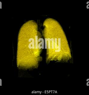 Trois dimensions de la reconstruction de la santé des poumons. Banque D'Images