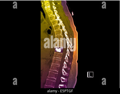 Renforcement de couleur sagittale scanner de la colonne vertébrale montrant dues à l'ostéoporose après compactage Banque D'Images