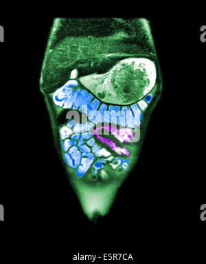 Couleur l'imagerie par résonance magnétique (IRM) de l'intestin grêle d'un enfant de 10 ans atteint de la maladie de Crohn, les murs de la Banque D'Images