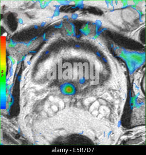 Couleur l'imagerie par résonance magnétique (IRM) montrant un cancer de prostate considéré comme un sport de couleur au centre. Banque D'Images