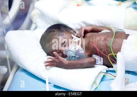 Bébé nouveau-né prématuré placé sous assistance respiratoire, département de néonatalogie, hôpital Robert Debré, Paris, France. Banque D'Images