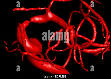 Traitement de la sténose carotidienne par angioplastie et stent prothèse, paramètre ici, reconstruction 3D des artères d'un patient avant Banque D'Images