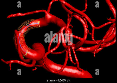 Traitement de la sténose carotidienne par angioplastie et stent prothèse, paramètre ici, reconstruction 3D pour choisir l'endoprothèse virtuelle Banque D'Images