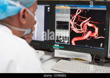 Traitement de la sténose carotidienne par angioplastie et stent prothèse, paramètre ici, reconstruction 3D pour choisir l'endoprothèse virtuelle Banque D'Images