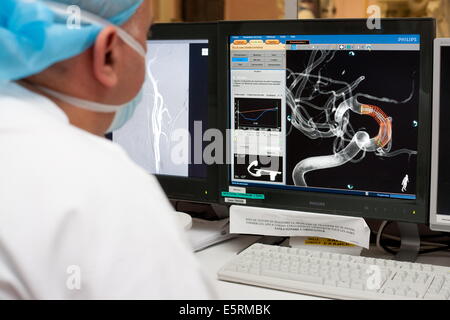 Traitement de la sténose carotidienne par angioplastie et stent prothèse, paramètre ici, reconstruction 3D pour choisir l'endoprothèse virtuelle Banque D'Images