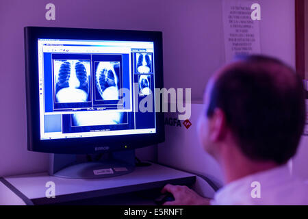 Radiographie thoracique d'une jeune fille de 13 ans souffrant de mucoviscidose. L'hôpital de Limoges, France. Banque D'Images