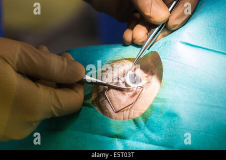 Retrait des donateurs de chirurgien de la cornée. La cornée sera cryostored et utilisés pour la transplantation de l'hôpital d'Angoulême, France. Banque D'Images