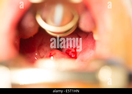 Traitement du ronflement l'amygdalectomie (ablation des amygdales), hôpital Foch, Suresnes, France. Banque D'Images