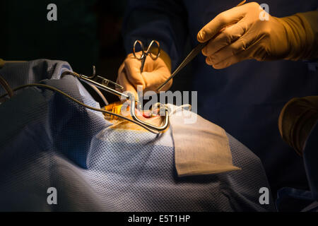 Traitement du ronflement l'amygdalectomie (ablation des amygdales), hôpital Foch, Suresnes, France. Banque D'Images