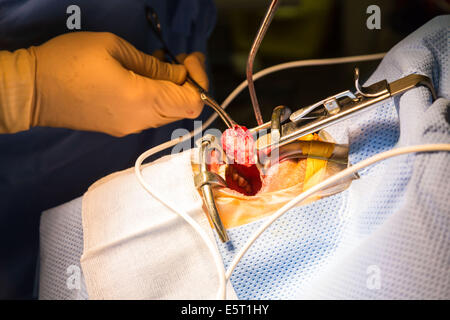 Traitement du ronflement l'amygdalectomie (ablation des amygdales), hôpital Foch, Suresnes, France. Banque D'Images