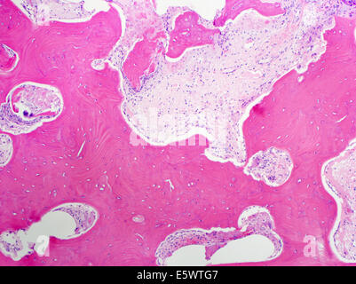 H&E teinté, la microscopie optique, la maladie de Paget de l'os Banque D'Images
