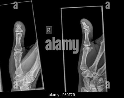 Radiographie d'un pouce avec une phalange distale cassée Banque D'Images