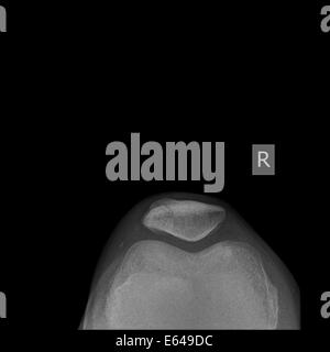 Fracture de la rotule du genou et de la radiographie d'un patient de sexe masculin âgé de 27 ans vue d'en haut Banque D'Images