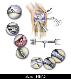 Détail de l'arthroscopie du genou montrant les procédures chirurgicales. Banque D'Images