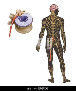 La sciatique causée par une hernie discale. Banque D'Images
