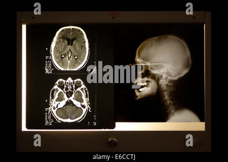 Radiographie de crâne et tomodensitométrie crânienne vue scan sur caisson lumineux Banque D'Images