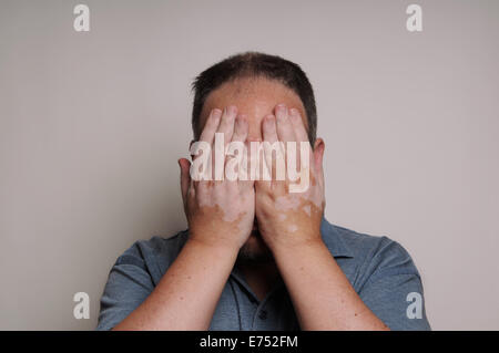 L'homme avec le vitiligo se cacher face Banque D'Images