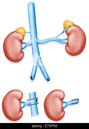 Rein Transplantation, illustration Banque D'Images