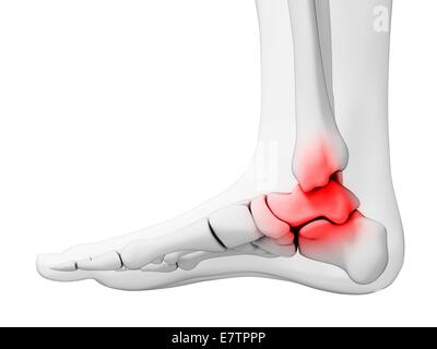 La douleur de la cheville, de l'artwork de l'ordinateur. Banque D'Images