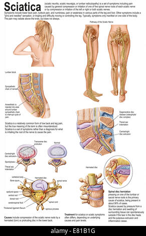 Dossier médical montrer les signes et symptômes de la sciatique. Banque D'Images