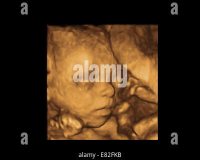 Le visage de foetus, de couleur 3-D échographie d'un fœtus, l'âge gestationnel : 23 semaines et 3 jours. Banque D'Images